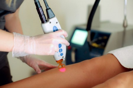 Epilation au laser