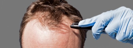 Les méthodes utilisées pour une greffe de cheveux