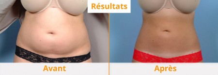 liposuccion abdominale avant après résultats